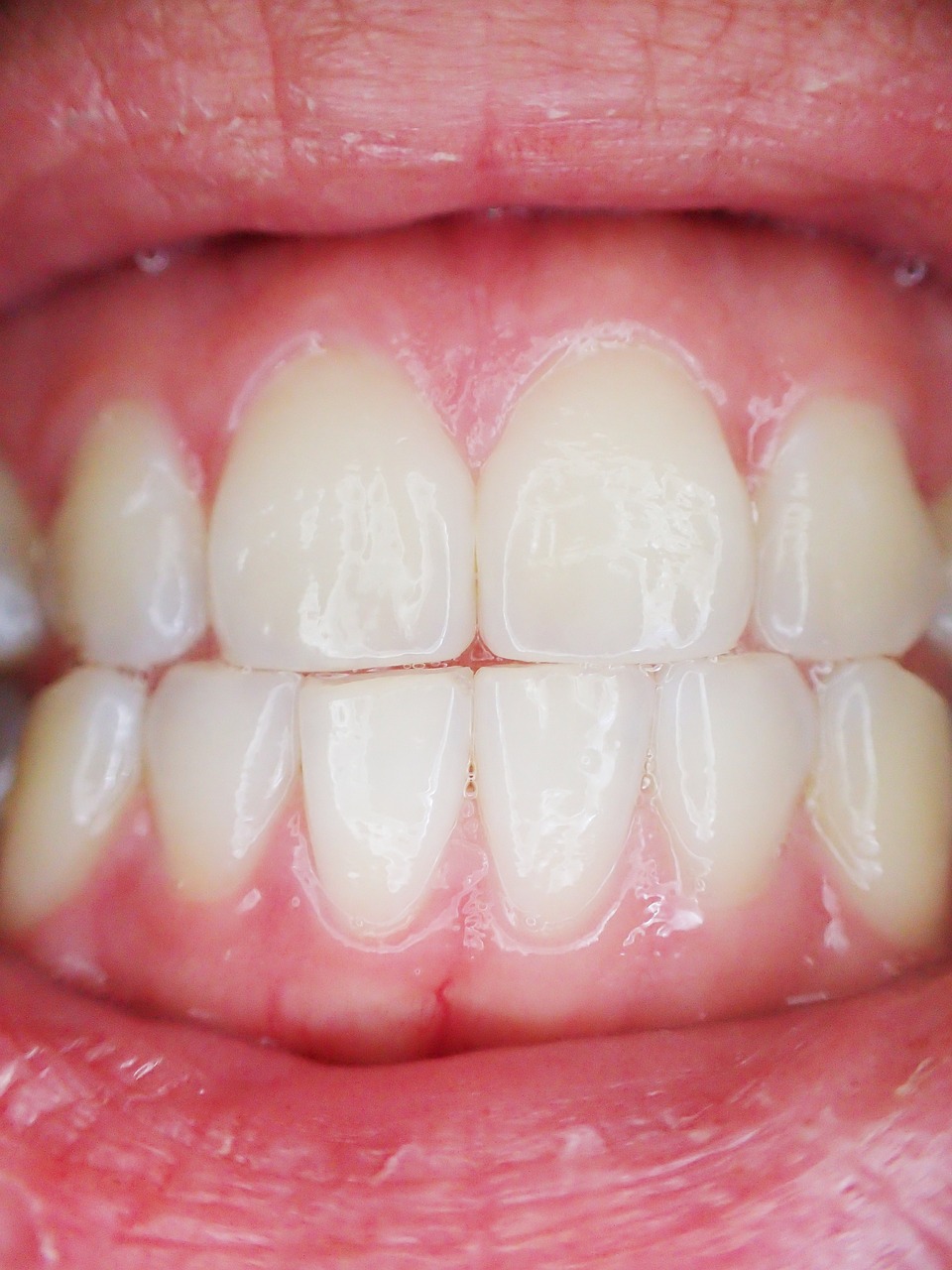 dental implant procedure Plantation - Bleeding Gums