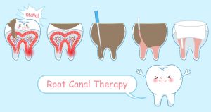 What Is a Root Canal and How Does the Procedure Work?