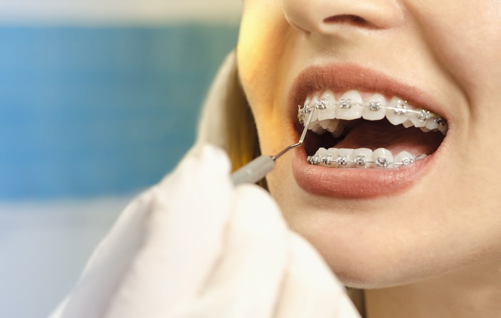 Braces Cost