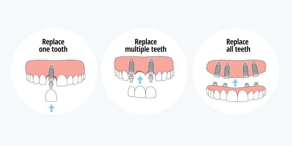 Dental Implants