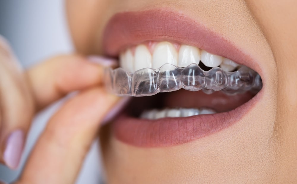 Plantation Blvd Invisalign
