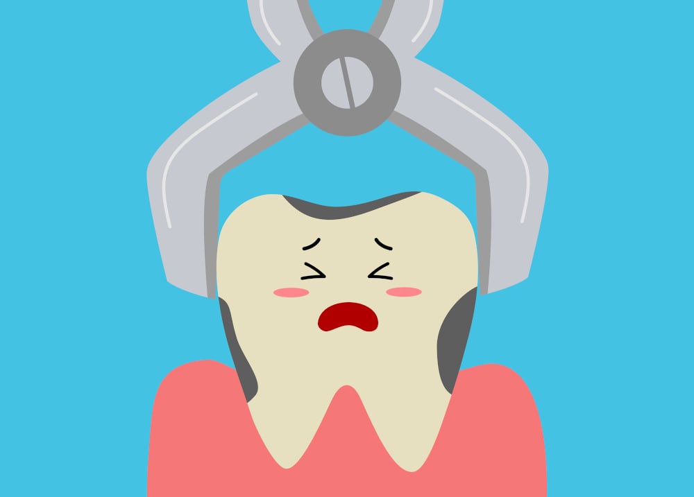 Tooth Extraction in Fort Lauderdale
